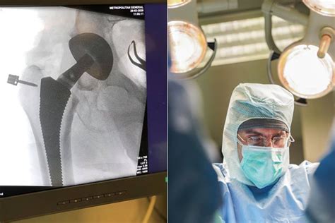 Superpath Hip Replacement With Navigation Minisco