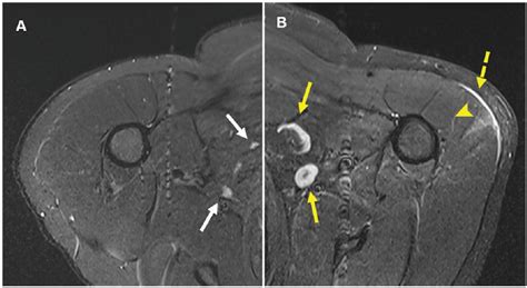 Lymphadenopathy In Covid 19 Vaccine Recipients Diagnostic Dilemma In