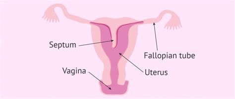 What Is Uterine Septum