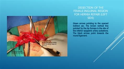 Hernia is a protrusion of tissue from its proper location through an existing or created opening. Inguinal hernia in a female
