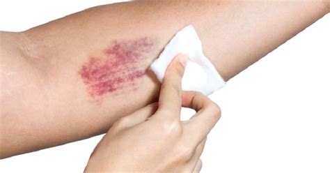 8 Natural Remedies For Healing A Bruise Fast David Avocado Wolfe