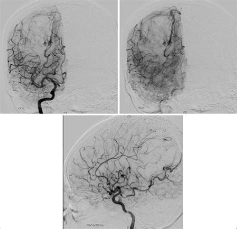 Digital Subtraction Angiography Showing Arteriovenous Malformation In