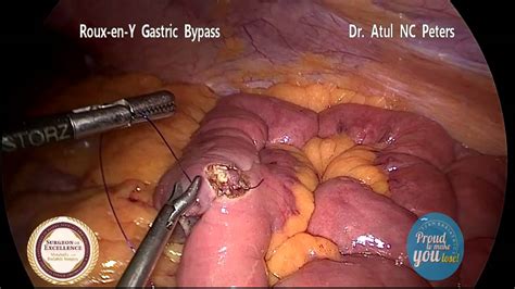 Food & drink 403 plays by: Laparoscopic Roux-en- Y Gastric Bypass surgery - Dr Atul ...