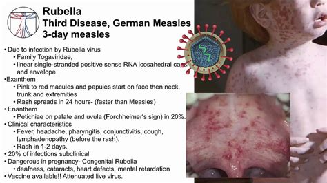 Measles And Vaccines Exanthems And Enanthems Youtube