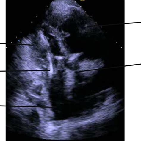 Apical 3‐chamber View Showing The Icd Shock Lead Clearly Going Through