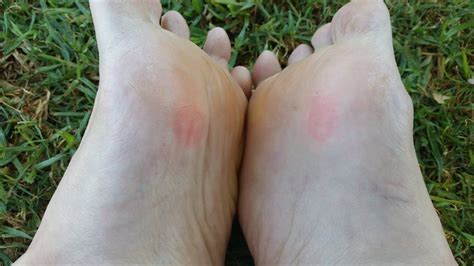 blister healing time how long does it take for a blister to heal blister prevention
