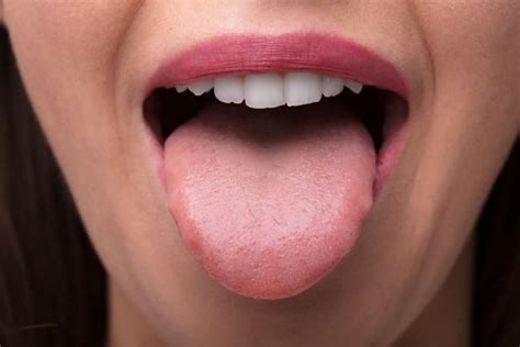 Bumps On The Tongue Transient Lingual Papillitis Facty Health