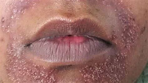 Dermatitis On Lip Ar