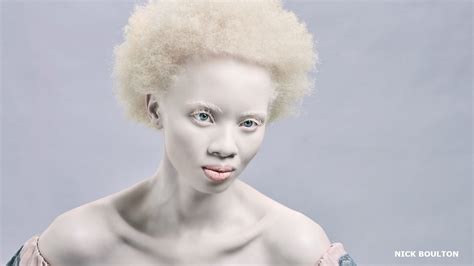 Bbc Living With Albinism