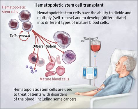 Stem Cell Treatments Stem Cell Transplantation Jama The Jama Network