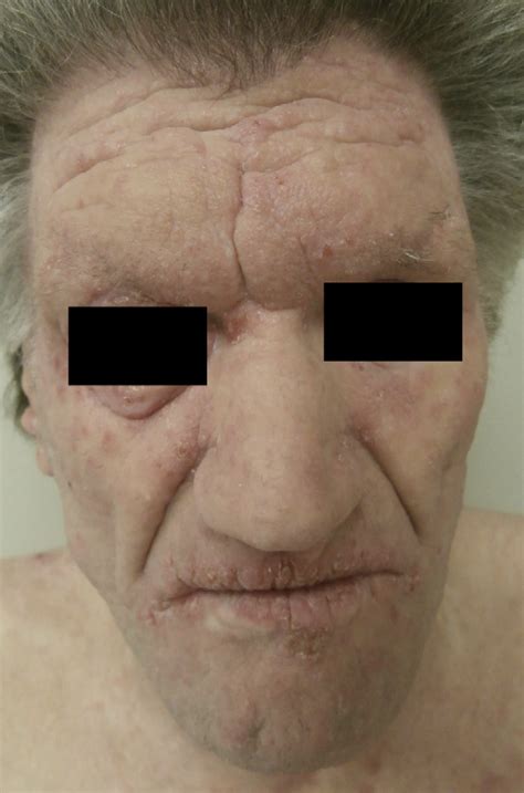 Figure 1 From Understanding And Managing Atopic Dermatitis In Adult