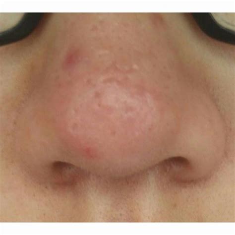 What Types Of Scars Are On My Nose With Pics Help Plz Scar Treatments Forum