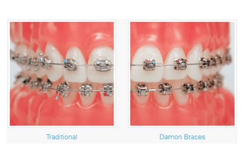 Damon Braces Orthodontic Services Burkhardt Pecora Orthodontics Dental Office Mi