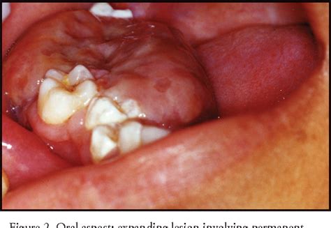 Figure 2 From Highly Aggressive Brown Tumor In The Jaw Associated With
