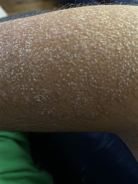 Dry Skin Like This All Over My Legs And Arms What Could This Possibly