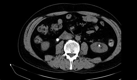 Recurrent Nephrolithiasis Leading To Renal Failure A Neglected Primary