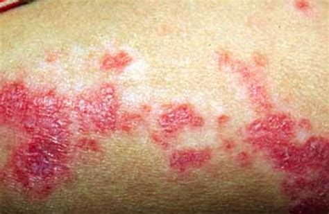 👉 Discoid Lupus Pictures Symptoms Treatment Causes December 2021