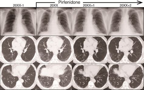 Radiograph Images During The Clinical Course Of Idiopathic Pulmonary