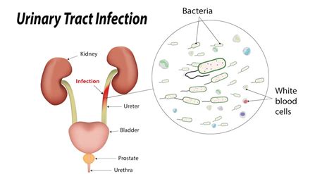 Urinary Tract Infection Symptoms Causes And Other Risk Factors