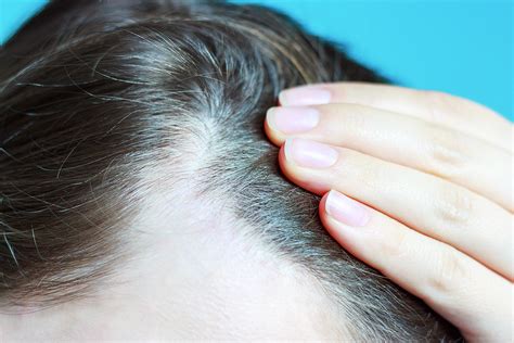 3 Non Surgical Hair Loss Treatments