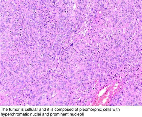 Pathology Outlines Leiomyosarcoma