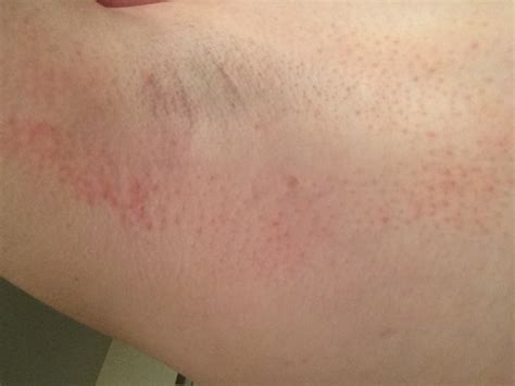 Rash Next To Armpit Why Photos Included Dermatology Forums Patient