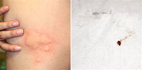 Bed Bug Bites On Thighs