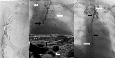 Intra Procedural Findings Lymphangiogram After Ethiodol Injection Into