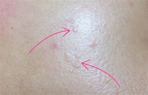 Common Lumps And Bumps On And Under The Skin What Are They Skin Bumps