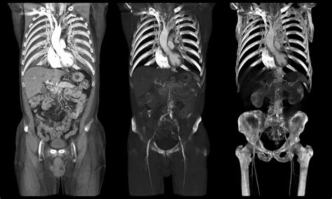 Pelvic Ct Scan