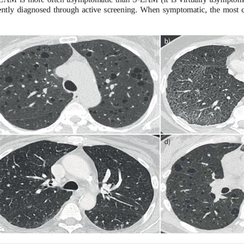 Pulmonary Manifestations Of Tuberous Sclerosis Complex Tsc And