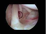 Pictures of Recovery From Biceps Tenodesis Arthroscopy Surgery