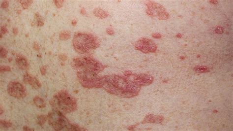 How To Identify Rashes And Other Lupus Skin Symptoms 2022