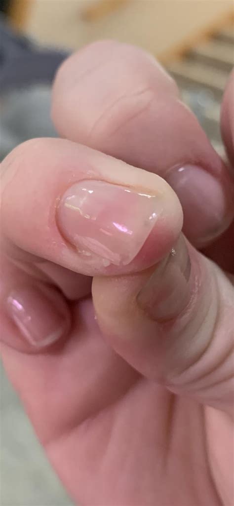 Fingernail Falling Offpeeling Rdermatologyquestions