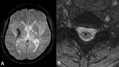 Axial T2 Weighted Image Low Signal In Right Basal Ganglia