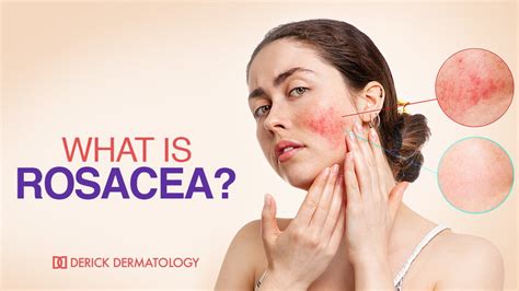 What Is Rosacea Derick Dermatology