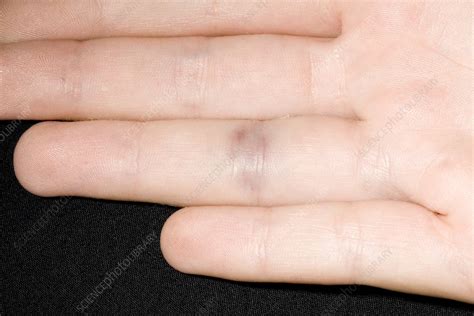 Bruised Finger Stock Image M3301765 Science Photo Library