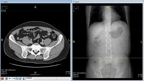 Abdominal Ct Scan With Iodinated Contrast L Youtube