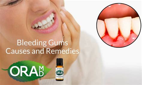 Bleeding Gums Causes And Remedies Oramd Blog