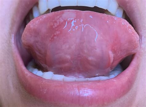 Bubble Under My Tongue 🍓Тяжи слизистой или бахромчатая складка