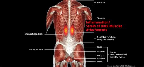 Check spelling or type a new query. Inflammation/Strain of Back Muscles Attachments ...
