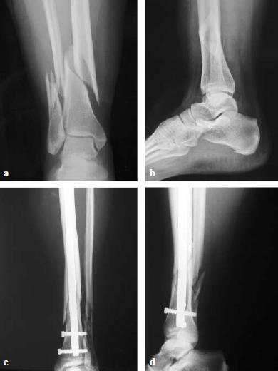 A Spiral Fracture Of The Distal Fibular And Distal Tibial Metaphysis