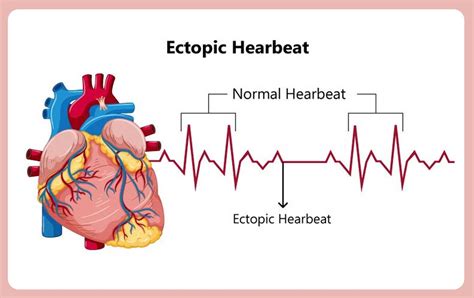 Ectopic Heartbeat Causes Symptoms Types And Ectopic Beats Treatment