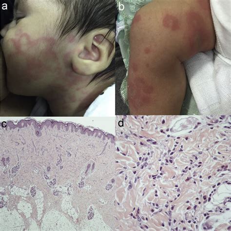 Pdf Urticaria Multiforme Two Cases With Histopathological Findings