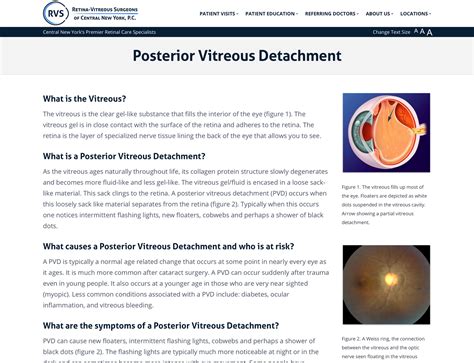 Posterior Vitreous Detachment Retina Vitreous Surgeons Of Cny