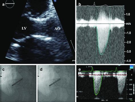 3 Imaging Features Of Prosthesis Patient Mismatch A Transcatheter