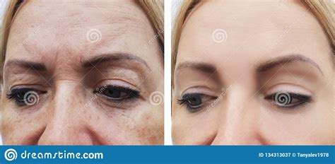 Woman Wrinkles Removal Dermatology Correction Face Before And After