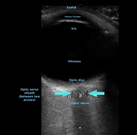 Figure Optic Nerve Sheath Measurement Contributed By Dr Claire
