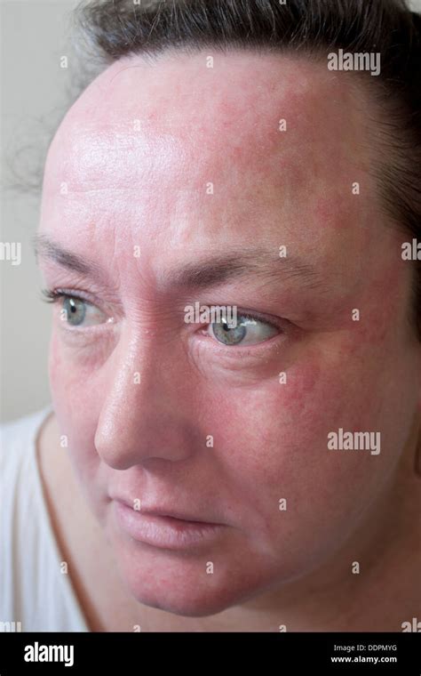Woman With Severe Eczema Allergic Reaction On Face Model Released Stock