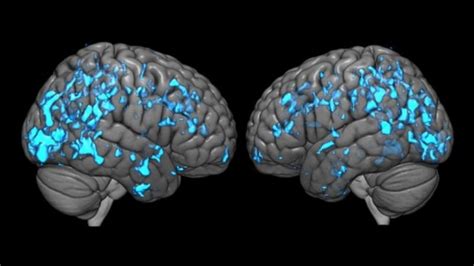 Deep Brain Stimulation Eases Parkinsons Disease Symptoms By Boosting